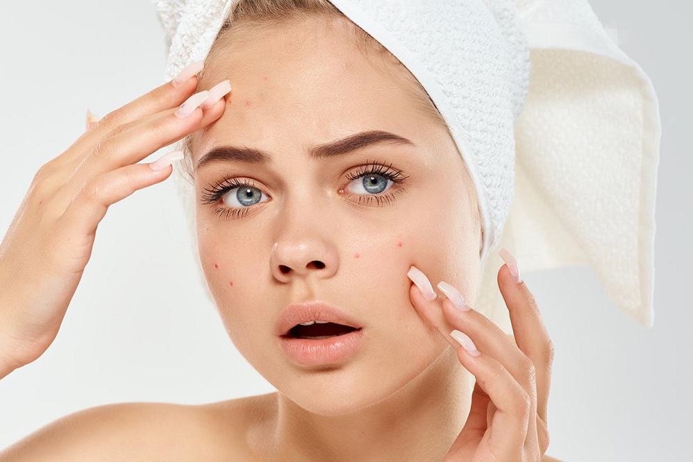 6 astuces pour combattre l’acné kystique