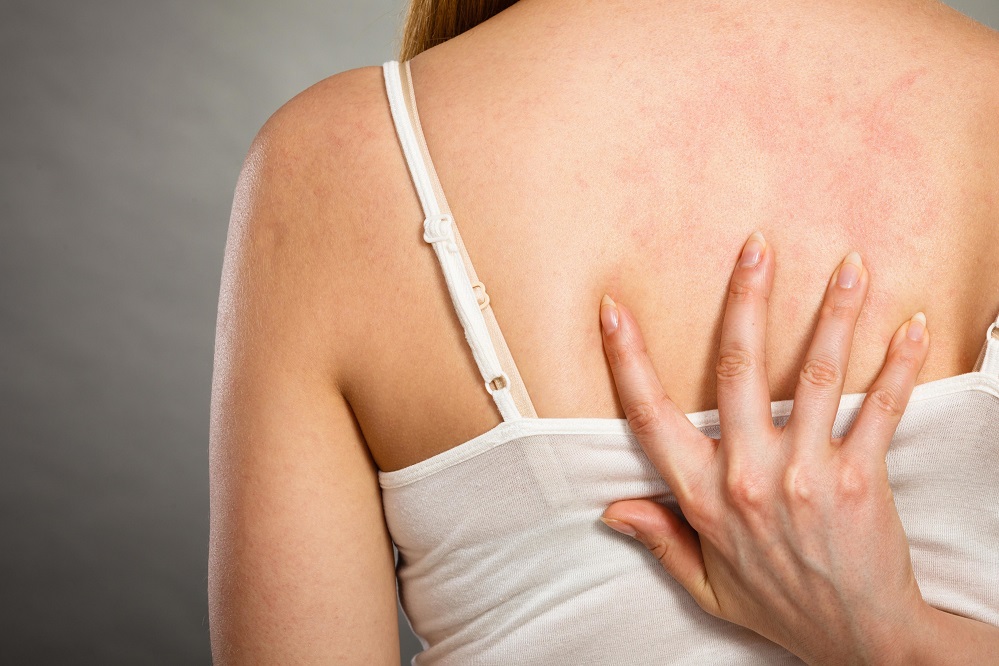 Comment se débarrasser de l'acné sur les épaules ?