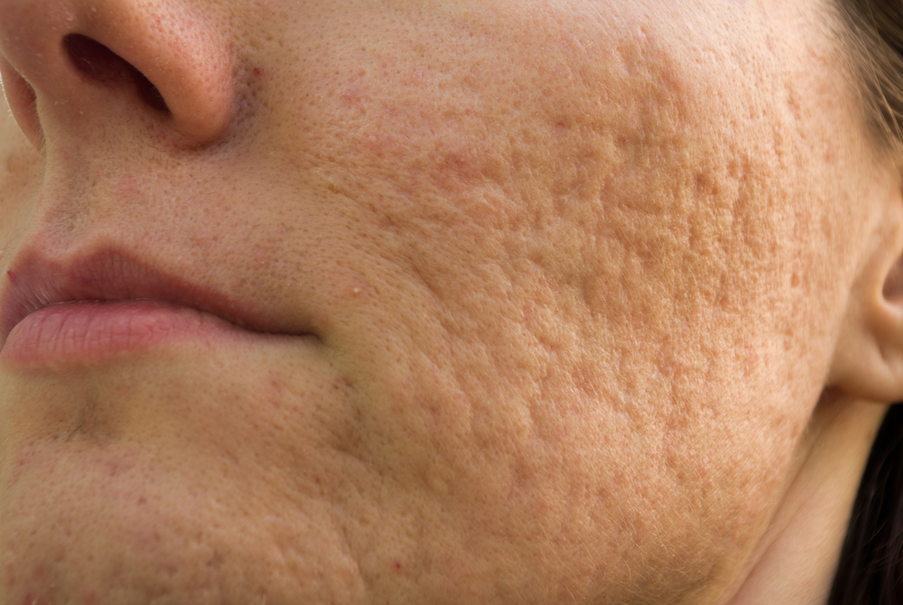 4 masques visage pour se débarrasser des cicatrices d’acné