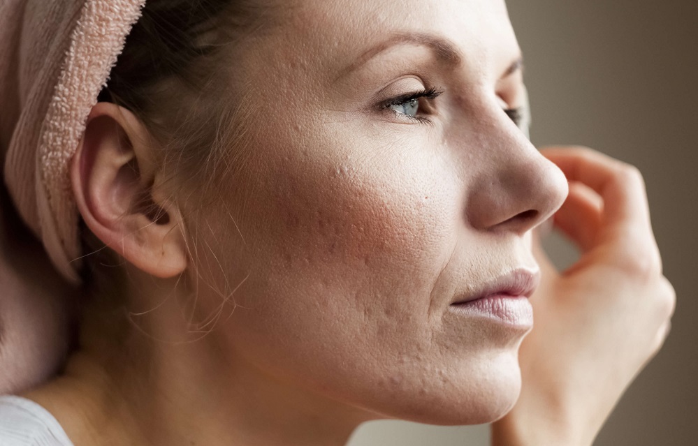 5 remèdes pour éliminer les cicatrices d’acné rapidement