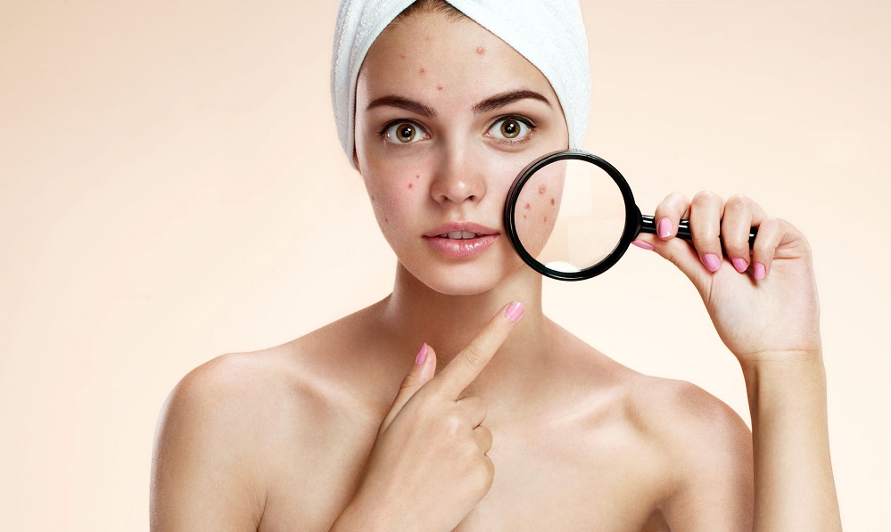 5 trucs et astuces pour neutraliser votre acné prouvés par la science