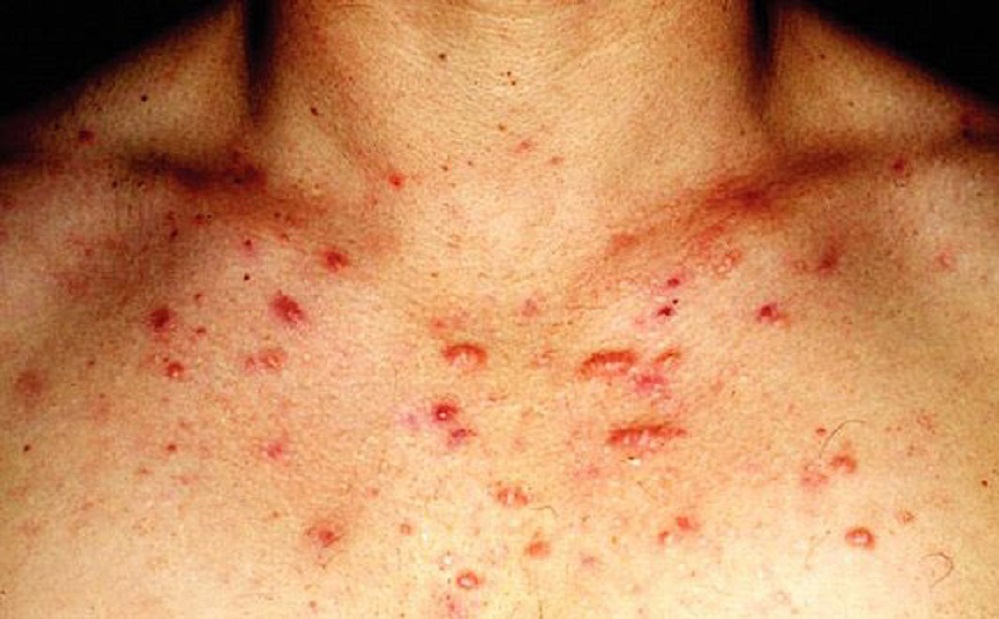 Comment se débarrasser de l’acné sur la poitrine ?