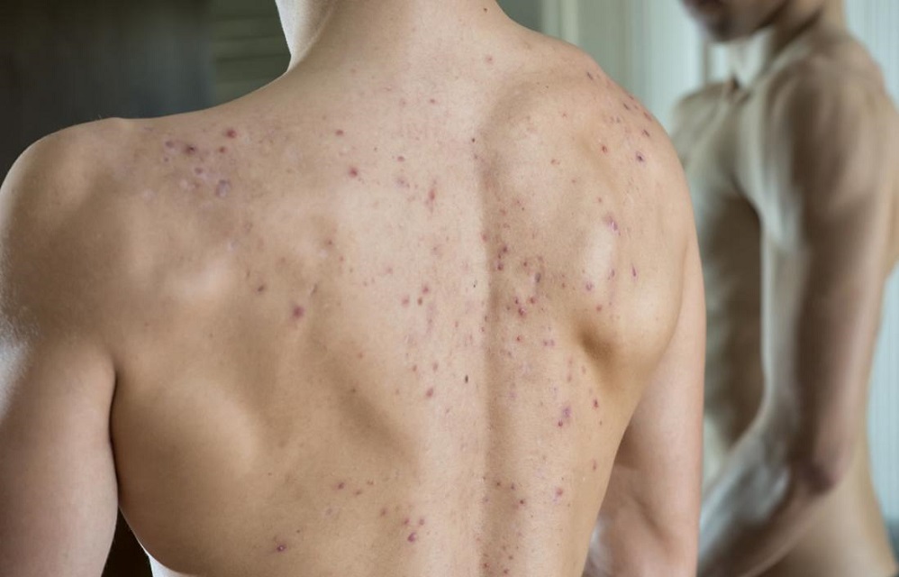 5 remèdes contre l’acné du dos