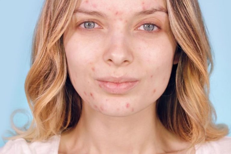 La vitamine B peutelle traiter l'acné ? DrSoleil