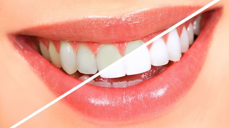 5 façons naturelles de blanchir vos dents
