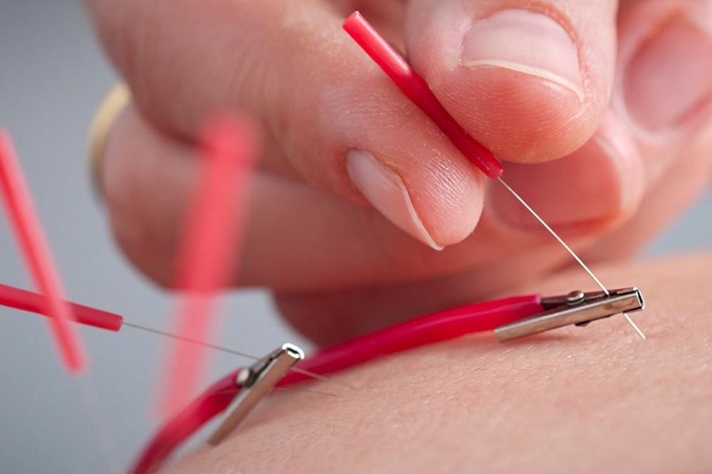 Qu'est-ce que l'électroacupuncture ?