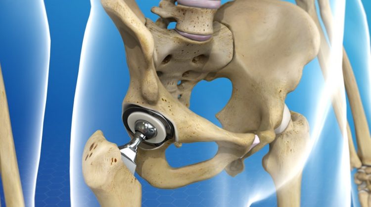 Remplacement de la hanche par voie antérieure : ce que vous devez savoir